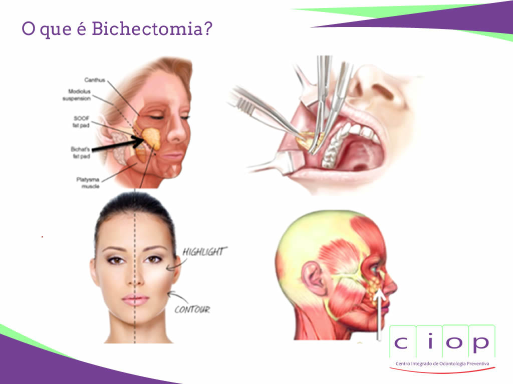 ciop bichectomia